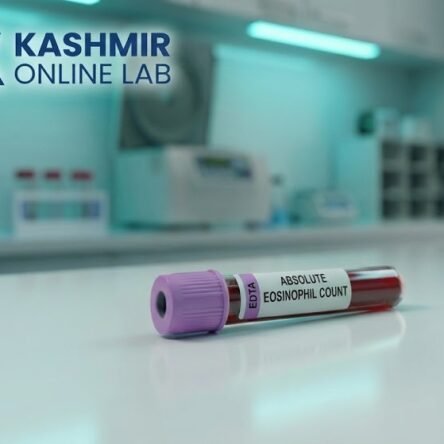 Absolute Eosinophil Count  Blood