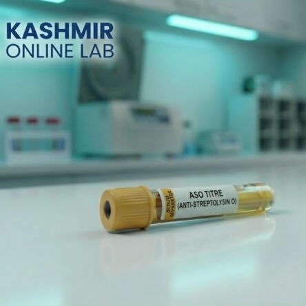 Anti Streptolysin O (Aso) Titre